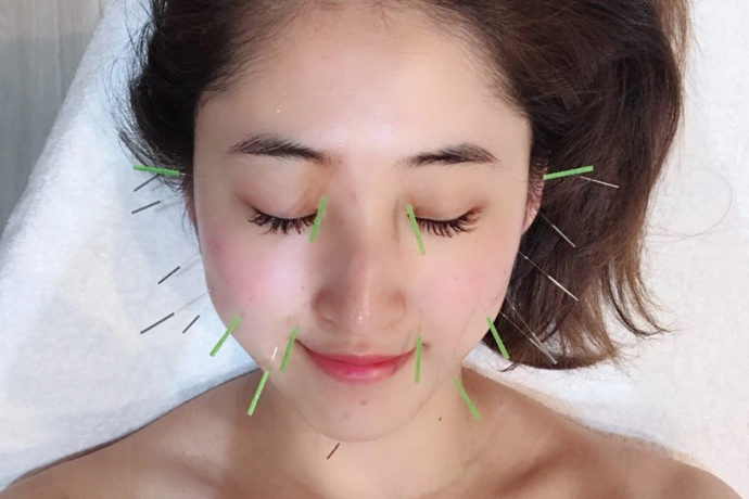 Cosmetic Acupuncture
