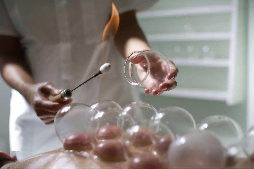 Cupping Treatment