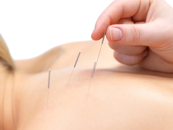 Traditional Chinese Acupuncture